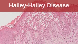 HaileyHailey Disease  Pathology mini tutorial [upl. by Ikin]