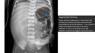 Segmental Volvulus Imaging [upl. by Kazim]