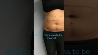 Full CoolSculpting Treatment with Before and Afters [upl. by Donoghue]