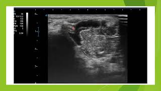 Echographie dun kyste poplité bursite du semi membraneux [upl. by Hilary84]