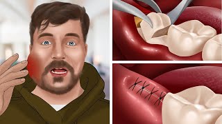 ASMR Animation Wisdom teeth treatment for MrBeast  WOW Brain Dental care [upl. by Persson767]