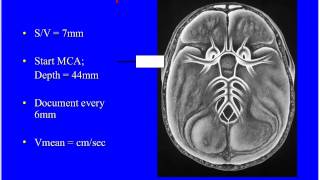 Natus TCD Webinar Transcranial Doppler and SAH [upl. by Lynd]