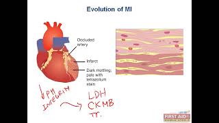 Myocardial infarction evolution pathology [upl. by Adnoloy320]