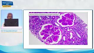 Paraproteinemia  MGRS  Dr N Gopalakrishnan [upl. by Ahtenek271]