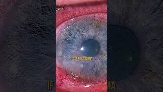 Glaucoma and the Carnivore Diet 👉 [upl. by Gilcrest]