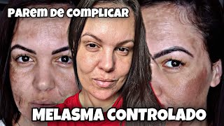 COMO CLAREAR O MELASMA DE VEZ [upl. by Lenwood142]