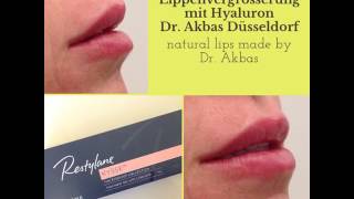 Lippen unterspritzen in Düsseldorf  Dr Akbas amp Dr Alt Arteo Klinik [upl. by Jerol]