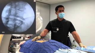 Radiofrequency Ablation Procedure [upl. by Yelsa]