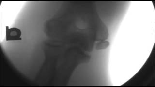 ELBOW MEDICAL EPICONDYLE AVULSION FRACTURE [upl. by Othello]