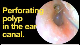 Perforating polyp in the ear canalear wax removal  ear cleaning  ASMR  relaxation  relax [upl. by Solotsopa]