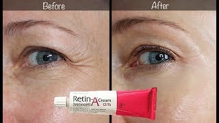 5Year RetinA Update  Before amp After for Wrinkles amp AntiAging [upl. by Moreen]