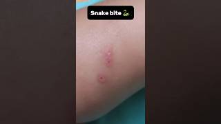 Snake bite 🐍  how snake bite look like snakebite snakebites snake science life humor shorts [upl. by Grubman]