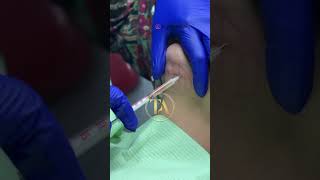 Lipolytic Injections timelessaesthetics drshikhabaghi [upl. by Eanram]