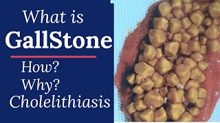 Gall stone disease Cholelithiasis surgitube [upl. by Japha451]