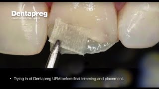 Restoration of Chipped Incisal Edge by Dr Dennis Hartlieb [upl. by Joshi]