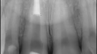 Coronal Tooth Fracture Related to Trauma and Root Canal Therapy [upl. by Hallock]