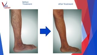 Before and After Varicose Veins and Ulcer Laser Treatment [upl. by Yllaw537]