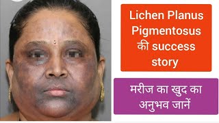 Lichen Planus Pigmentosus patient own experience LPP का इलाज lichenplanus LichenPlanusPigmentosus [upl. by Ettesoj894]