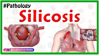 Silicosis Miners phthisis Grinders asthma  Etiology  Pathophysiology  Diagnosis Treatment [upl. by Anayeek]