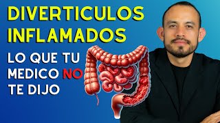 📛 DIVERTICULITIS Síntomas Diagnostico y Tratamiento 2024 [upl. by Leoni560]