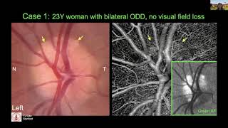 Human Measurements amp Biomarkers of Optic Neuropathies Multi spectral ophthalmic imaging in ODD [upl. by Eilac]