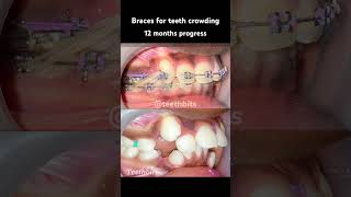 Crooked teeth Braces in 12 months progress braces orthodontics dental dentist teethbits [upl. by Treiber]