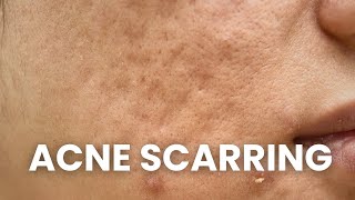 HOW TO TREAT ACNE SCARS  DOCTORLY [upl. by Nyrb]