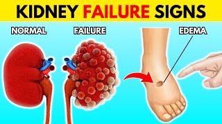 Shocking Kidneys Failure Symptoms You Should Never Ignore [upl. by Kcerb]