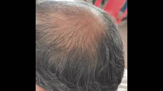 prp hair treatment besthairtransplant hairstyle hairfall [upl. by Vigor]