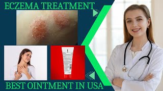 eczema treatment eczema causes and Ointment [upl. by Saffier]