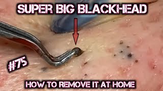 Satisfying Videos  Pimples Popping  Blackheads  Acne amp Cysts Compilation 75 [upl. by Ellekcir]