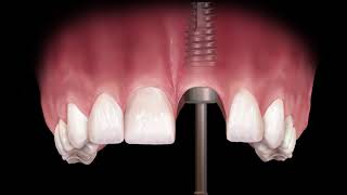 MultiPurpose Abutment to Fabricate a Custom Abutment [upl. by Retxed]