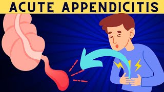 Acute Appendicitis Signs And Symptoms Risk Factors Diagnosis And Treatment [upl. by Terencio]