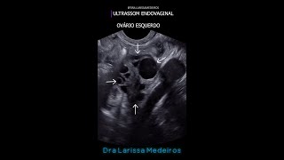 OVÁRIO ESQUERDO  Ultrassom endovaginal [upl. by Leddy]