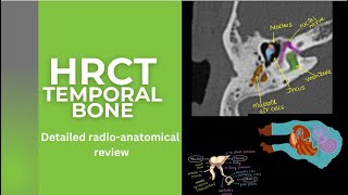 HRCT TEMPORAL BONE Illustrations and detailed radioanatomy on HRCT FACIAL NERVE on HRCT T BONE [upl. by Atilrak690]