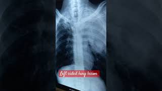 Left sided lung lesion [upl. by Annavaj]