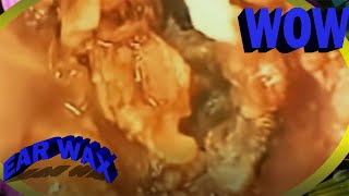 How To removal earwax at home with hydrogen peroxide ear wax removal Spa EP151 [upl. by Lani]