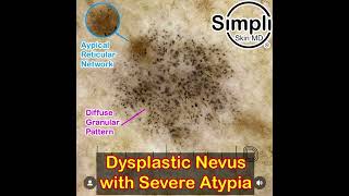 Severely Dysplastic Nevus Dermoscopy [upl. by Dera]