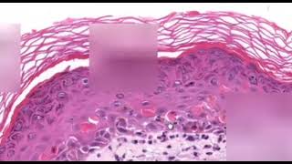 Erythema Multiforme Dermatopathology Easy learning [upl. by Chessa]