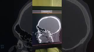 Nasal and zygomatic bone fracture  sagittal view of Ct brain bone window [upl. by Orteip]