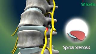 Micro Lumbar Discectomy amp Fusion  Spine Surgery Neuro Surgery Fortis HealthcareIndia [upl. by Quincey]