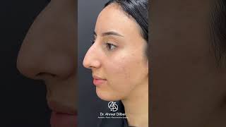 Rhinoplasty Turkey 👃🏻 Dr Ahmet Dilber 🪄 rhinoplastyturkey plasticsurgery rhinoplasty [upl. by Chladek]