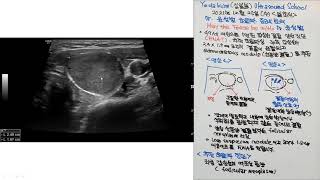 Yoda Kim Ultrasound School1455  Dr윤성법 증례 좌측 갑상선 여포성 종양 [upl. by Hoxsie533]