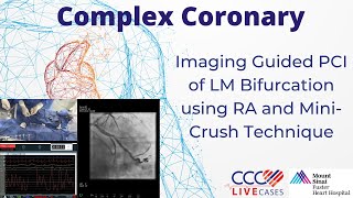 Imaging Guided PCI of LM Bifurcation using RA and MiniCrush Technique [upl. by Nalym601]