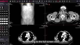 MedDream DICOM Viewer the full screen view [upl. by Perrins]