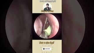 귀지형 콧물 부비동염 축농증 비염 코청소 이비인후과 rhinorrhea rhinitis sinusitis ASMR [upl. by Watkins]