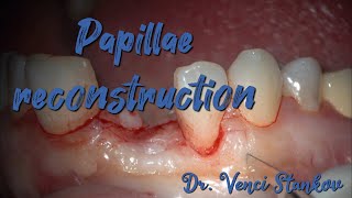 Papillae reconstruction in dental practice Dental surgery operation Dr Venci Stankov [upl. by Ranitta]