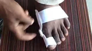 Bunion splint correcter use and review pair ka angutha Sahi karne ka Tarika gd medical point [upl. by Tray716]