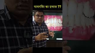 पायरिया का इलाज  gumdisease shorts [upl. by Odab904]