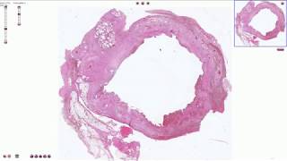 Chronic Cholecystitis  Histopathology [upl. by Ecinrev447]